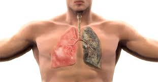 ANS incorpora medicamento para tratar câncer de pulmão